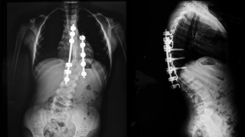 An x-ray taken of a person with scoliosis. Tallaght Hospital has been accused in the Dáil of engaging in an ‘arse covering exercise’ by confirming surgery for a scoliosis patient only after being contacted by the Minister for Health. Image: iStock.