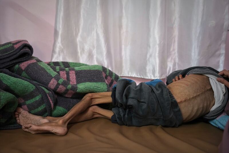 Mona al-Raqab lifts the shirt of her five-year-old son, Osama al-Raqab, revealing signs of malnutrition and worsening cystic fibrosis, exacerbated since the start of the war by the shortage of meat, fish, and enzyme tablets needed to help him. Photograph: Abdel Kareem Hana/AP